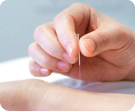 Acupuncture Needles
