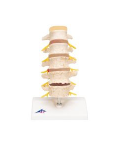 Spine Degeneration Model [Pack of 1]