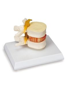 Prolapsed Disc Spinal Simulator [Pack of 1]