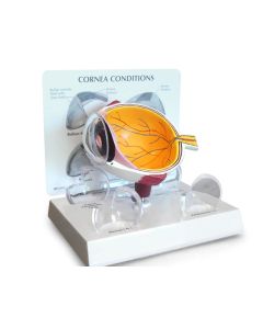 Cornea Conditions Eye Model [Pack of 1]
