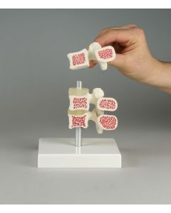 Osteoporosis Vertebrae Model [Pack of 1]
