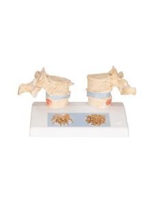Osteoporosis of the Thoracic Spine Model [Pack of 1]