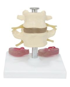 Lumbar Vertebra Model with Interchangeable Discs (6 part) [Pack of 1]