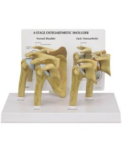 Shoulder Osteoarthritis Model Set (4 stages) [Pack of 1]