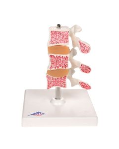 Osteoporosis Model (3 Vertebrae) [Pack of 1]