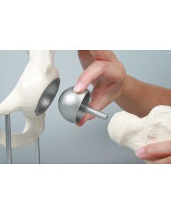 Hip Joint Model with Birmingham Hip Resurfacing [Pack of 1]