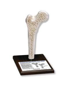 Osteoporosis Model [Pack of 1]