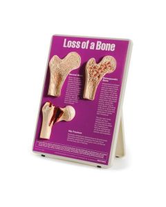 Loss of a Bone Easel Display [Pack of 1]