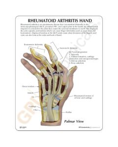 Rheumatoid Arthritis (RA) Hand Model [Pack of 1]