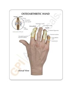 Osteoarthritis (OA) Hand Model [Pack of 1]