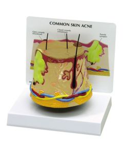 Skin Acne Model [Pack of 1]