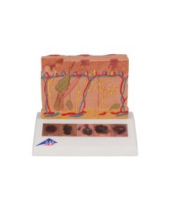 Skin Cancer Model (8 times life size) [Pack of 1]