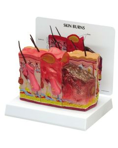 Skin Burn and Normal Skin Anatomical Model [Pack of 1]