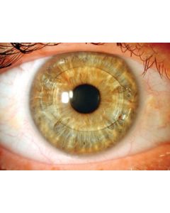 Artiflex Myopia Model 401 6mm/8.5mm U -11.5 40114SW23N [Pack of 1]