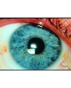 Artisan Hyperopia Model 203 8.5mm/5.0mm U  3.0 203001W06 [Pack of 1]