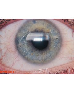 Artisan Hyperopia Model 203 8.5mm/5.0mm U  6.0 203001W12 [Pack of 1]