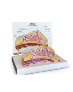 Breast Pathologies Anatomical Model [Pack of 1]