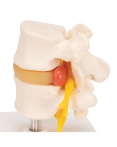 Lumbar Spine Model with Prolapsed Intervertebral Disc [Pack of 1]