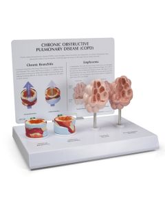 COPD Model (4 part) [Pack of 1]