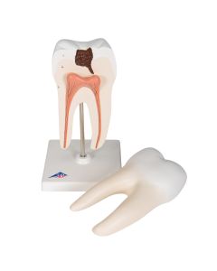 Lower Twin-Root Molar Model showing Cavities (2 part) [Pack of 1]