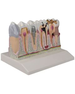Tooth Disease Model (4 times life size) [Pack of 1]