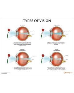 Types of Vision Chart / Poster - Laminated [Pack of 1]