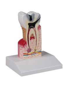 Tooth Decay Model (10 times life size) [Pack of 1]