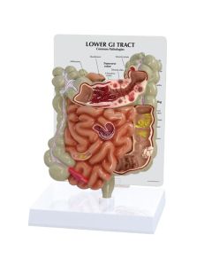 Lower GI Tract with Pathologies Model [Pack of 1]