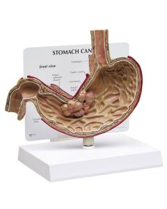 Stomach Cancer Model [Pack of 1]