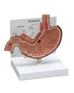 Stomach Ulcer Anatomical Model [Pack of 1]