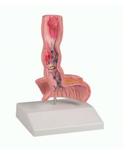 Oesophagus Diseases Model [Pack of 1]