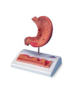 Stomach Model With Ulcers [Pack of 1]