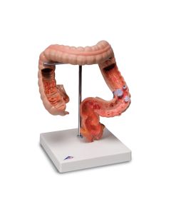 Intestinal Diseases Model [Pack of 1]
