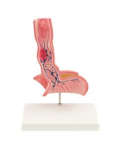 Oesophagus Diseases Model (1/2 life size) [Pack of 1]