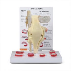 Knee Meniscus Tears Model [Pack of 1]