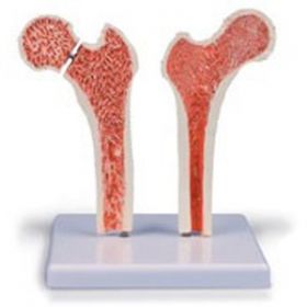 Erler Zimmer Osteoporosis Femur [Pack of 1]