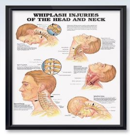 Anatomical Chart - Whiplash Injuries of the Head and Neck