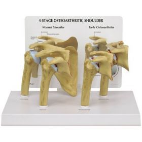 Shoulder Osteoarthritis Model Set (4 stages) [Pack of 1]