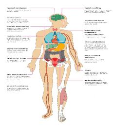 Anatomical Chart - The Immune System: Allergic Response