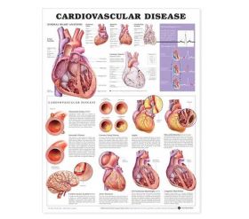 Anatomical Chart - Cardiovascular Disease, 2nd Edition