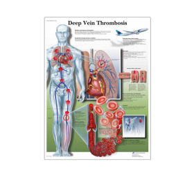 Anatomical Chart - Deep Vein Thrombosis