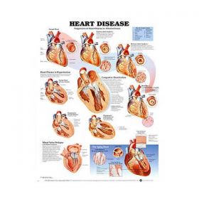 Anatomical Chart - Heart Disease, 2nd Edition