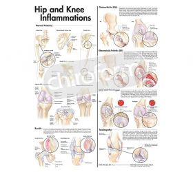 Anatomical Chart - Hip and Knee Inflammations, 2nd Edition