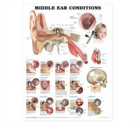 Anatomical Chart - Middle Ear Conditions, 2nd Edition