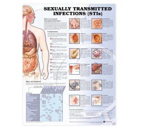 Anatomical Chart - Sexually Transmitted Infections (STIs), 2nd Edition