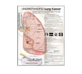 Anatomical Chart - Understanding Lung Cancer