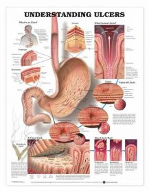 Anatomical Chart - Understanding Ulcers