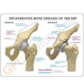 Degenerative Bone Diseases of the Hip Model (4 stages) [Pack of 1]