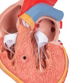 Heart Model with Left Ventricular Hypertrophy (2 part) [Pack of 1]