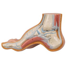 Hollow Foot Model (Pes Cavus) [Pack of 1]